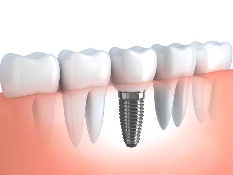 Dentist reviewing dental implant options with a patient in Dania Beach, FL